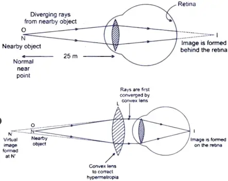 Explain using ray diagrams how the defect associated with hypermetropic eye can be corrected. 